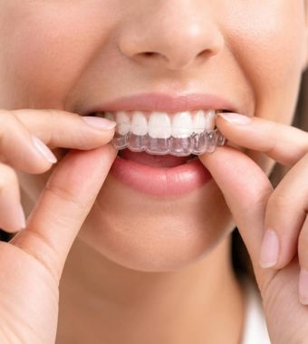invisalign