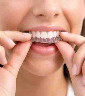 invisalign