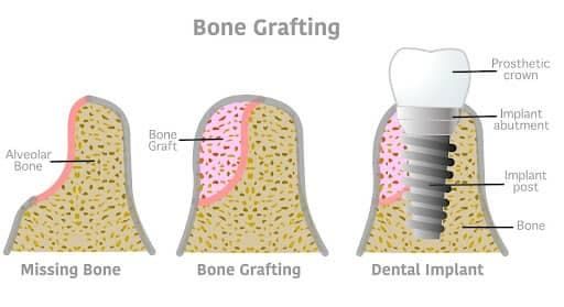 Dental Bone Grafting Ottawa