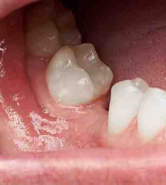 bone grafting