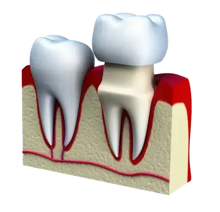 Crown Lengthening Ottawa