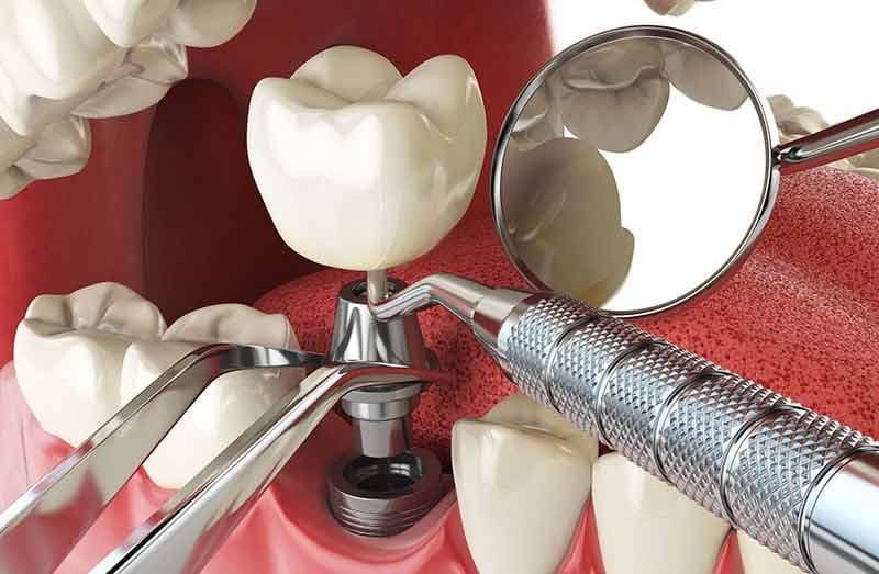 Dental Implants Ottawa