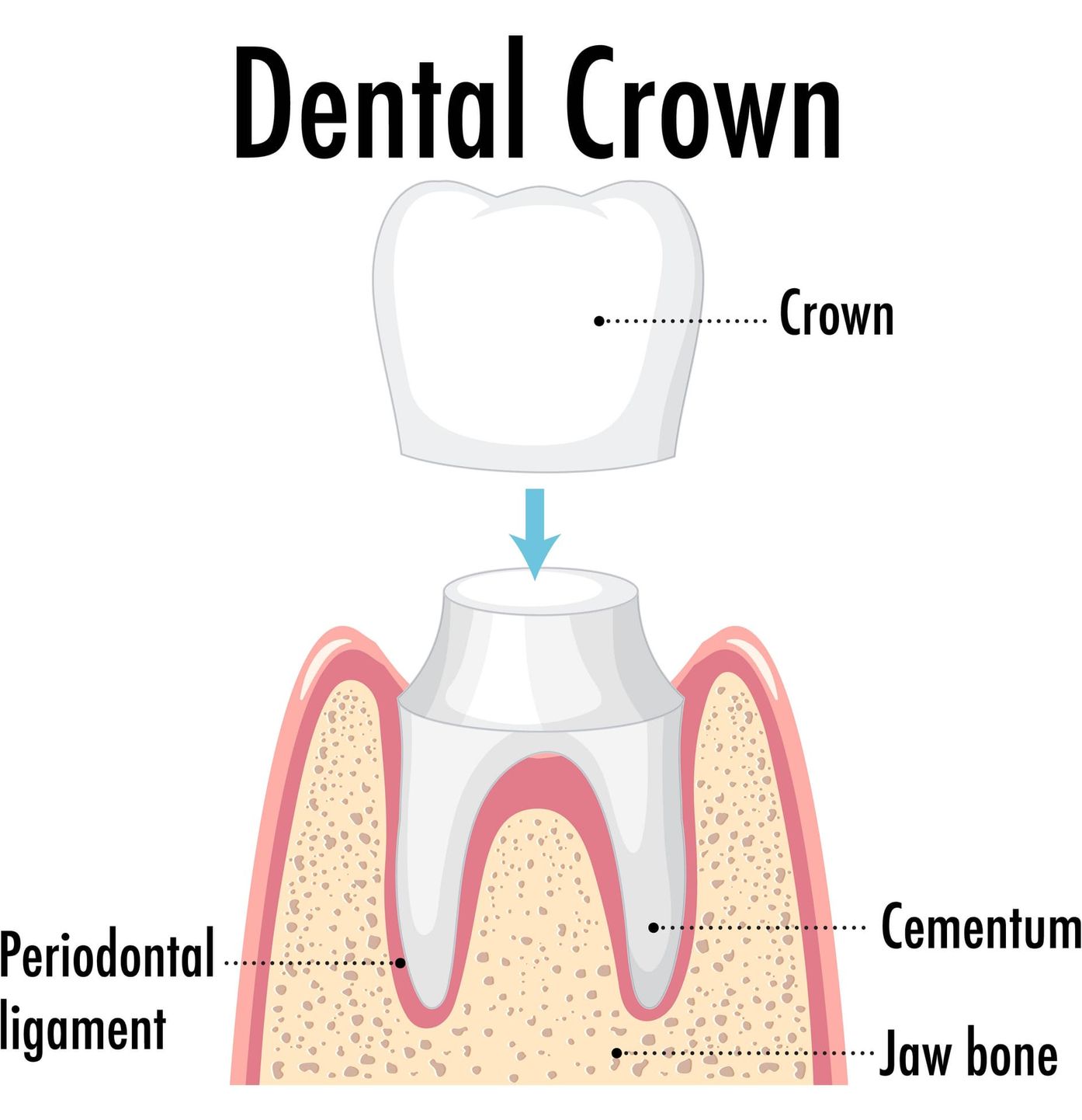 Dental Crowns Ottawa