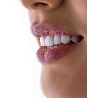 dental veneers