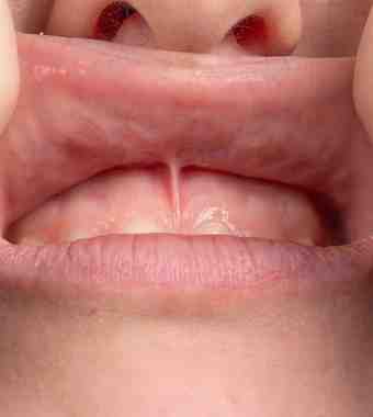 frenectomy