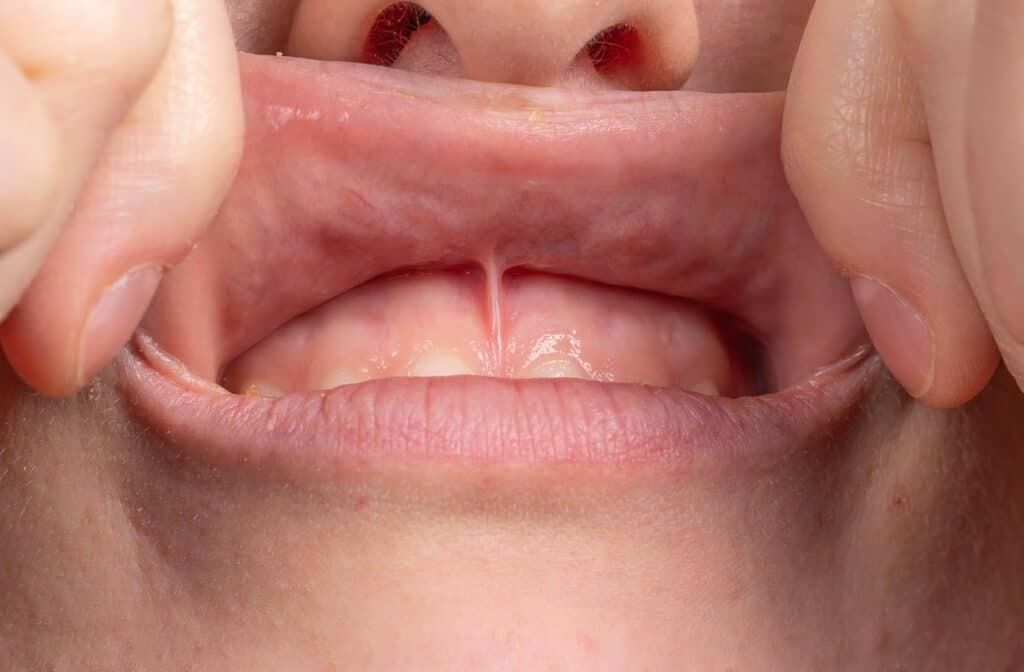 Frenectomy Ottawa