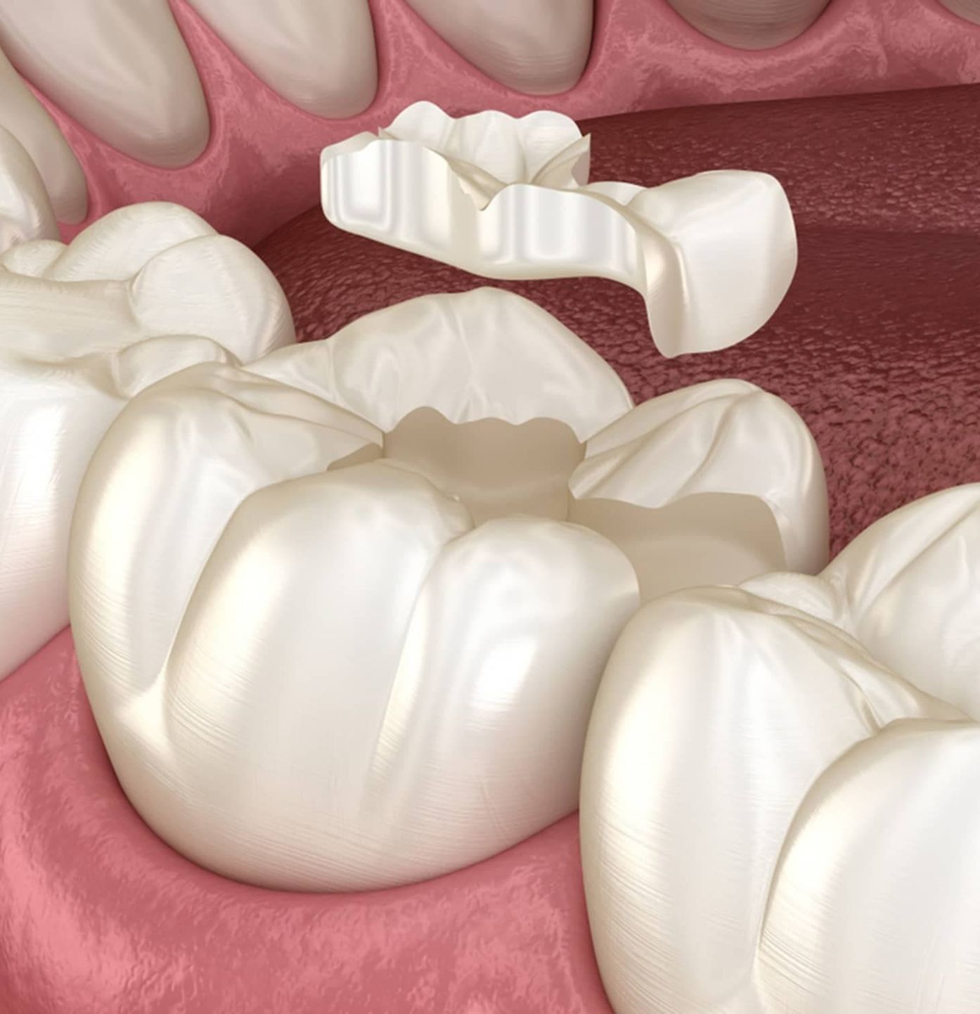 Dental Inlays and Onlays Ottawa