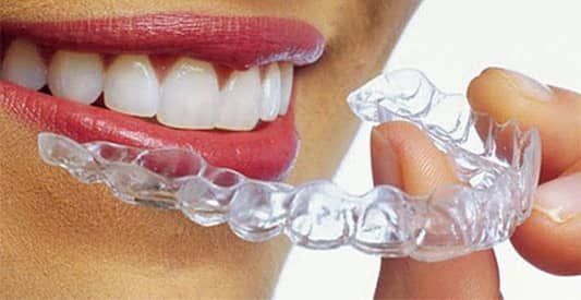 Invisalign Ottawa