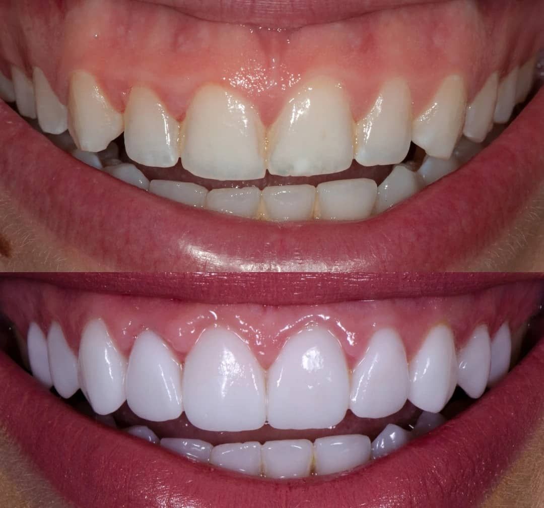Laser Gum Contouring Ottawa
