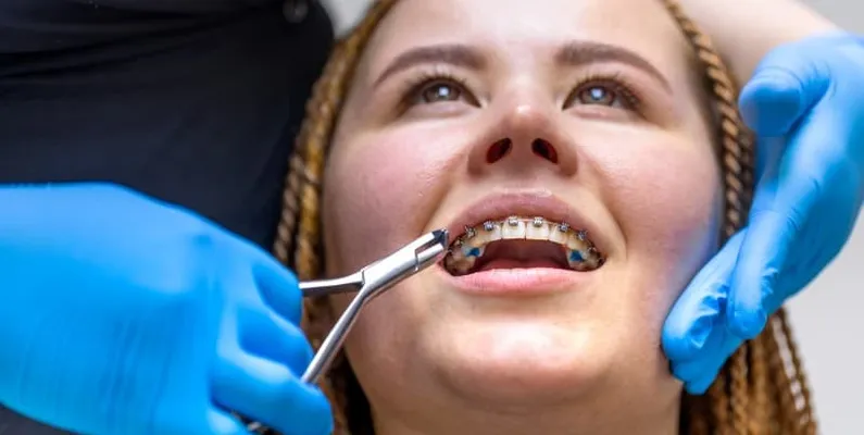 orthodontic treatment in Ottawa and Orleans