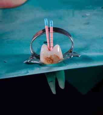 root canal treatment