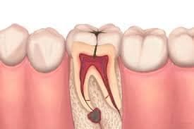 Root Canal Ottawa