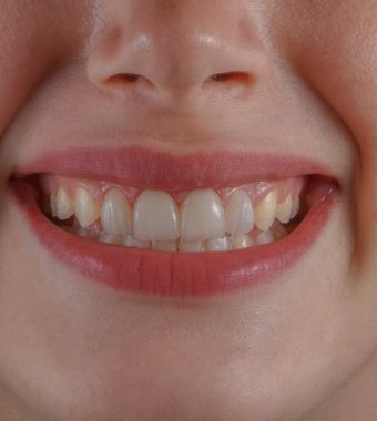 teeth whitening
