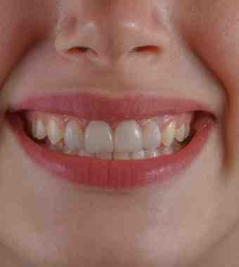 teeth whitening