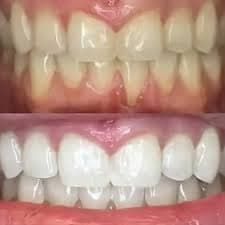 Teeth Whitening Ottawa