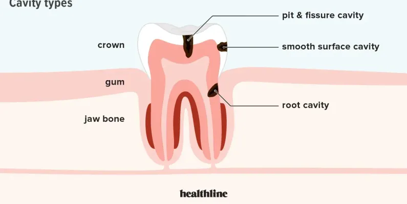Types of cavities