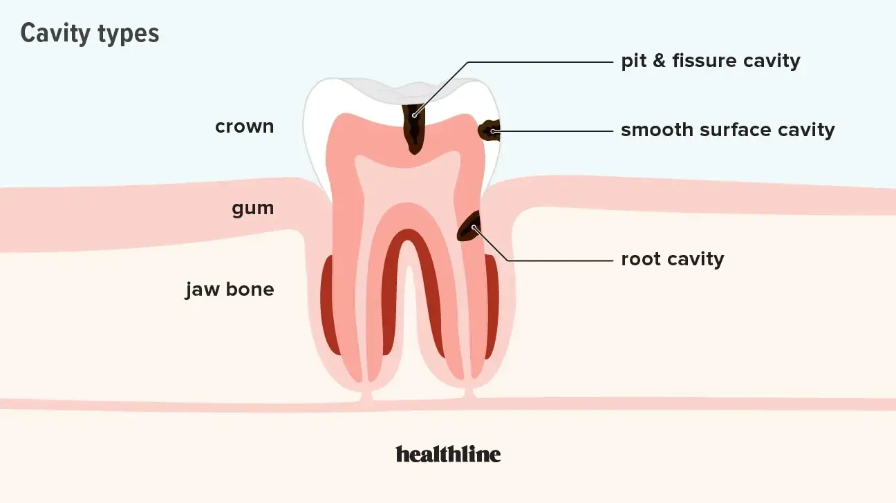 Types of cavities