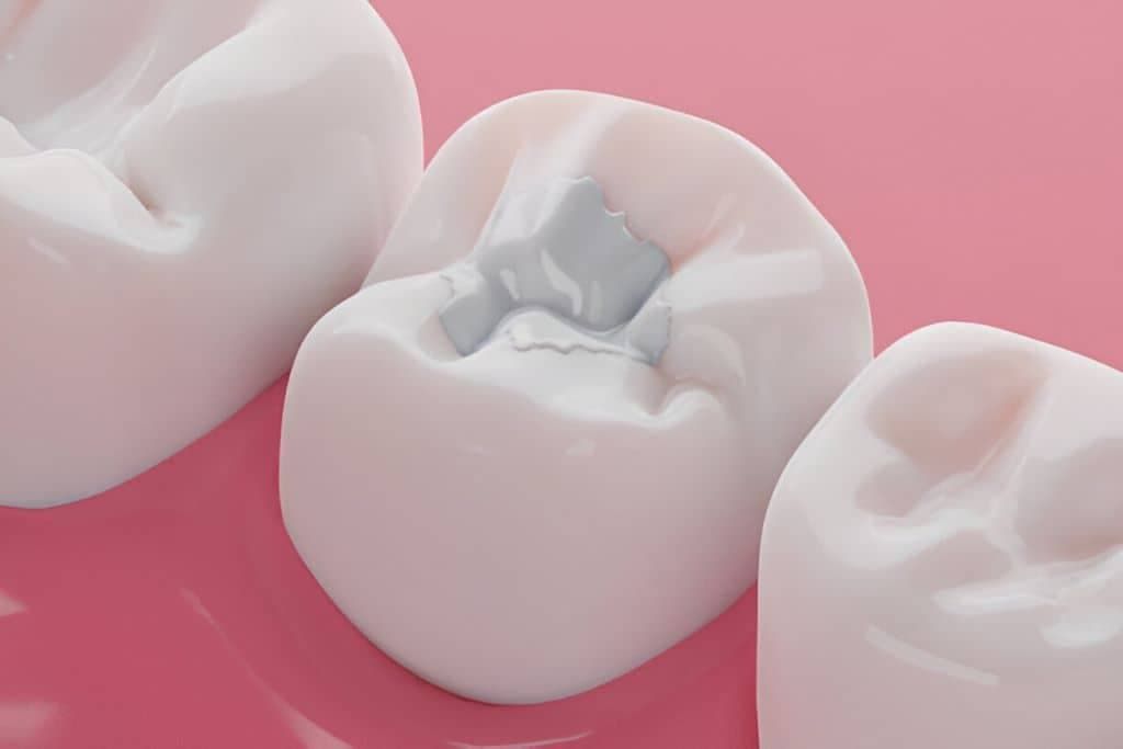 Composite White Fillings Ottawa