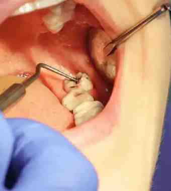 wisdom teeth removal