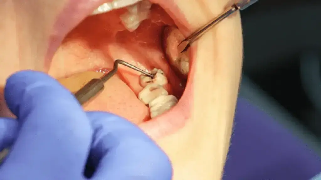 Wisdom Teeth Removal Ottawa