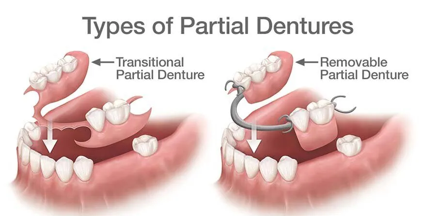 Types of partial dentures