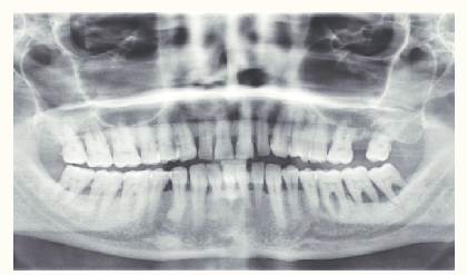 diabetic patient with severe periodontal destruction