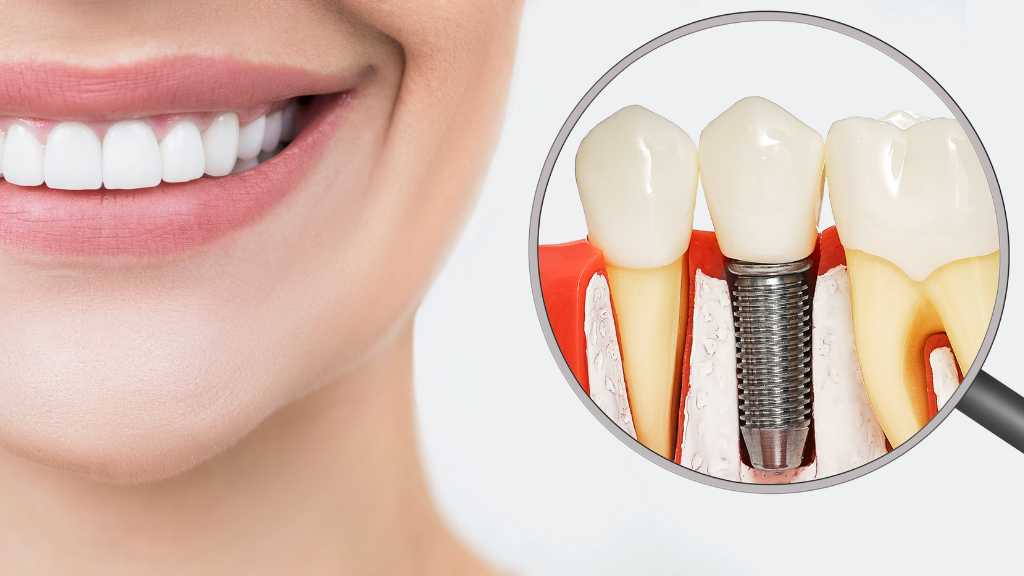Unlocking Your Perfect Smile: A Guide to Modern Dental Implants